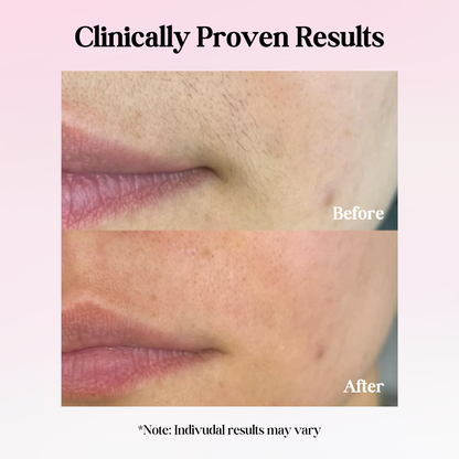 Cypra Beauty - Cyperus Rotundus Oil for Permanent Hair Reduction